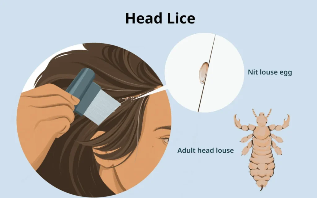 Life Cycle of Head Lice